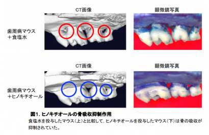 新潟大学院生らと小林製薬の研究グループが、植物由来成分による歯周病予防効果を発見